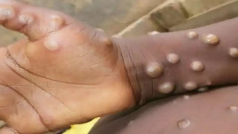 यसरी पत्ता लगाउन सकिन्छ मंकीपक्स संक्रमण